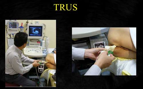 Ultrasound guided TRUS prostate biopsy in Delhi