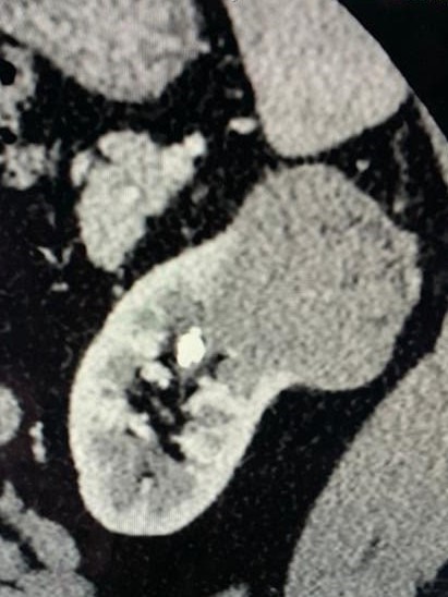 kidneycancerctscan