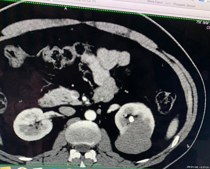 kidneycancerctscan2