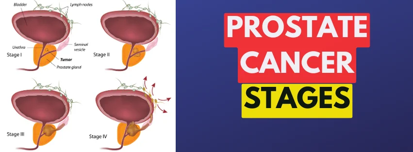 PROSTATE CANCER STAGES