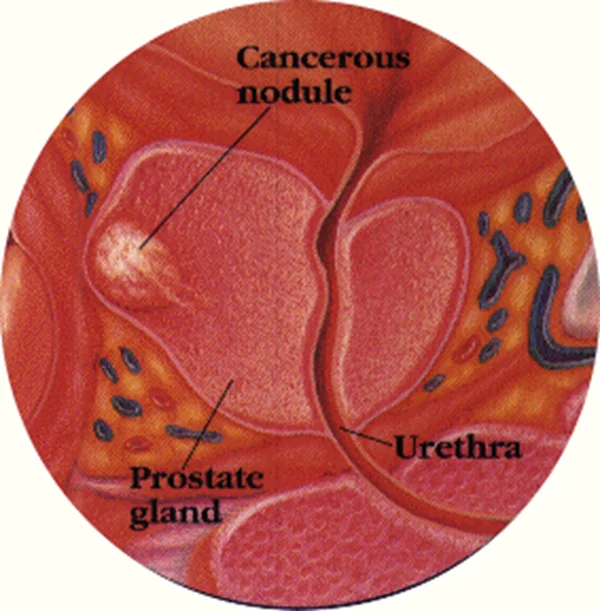 prostate