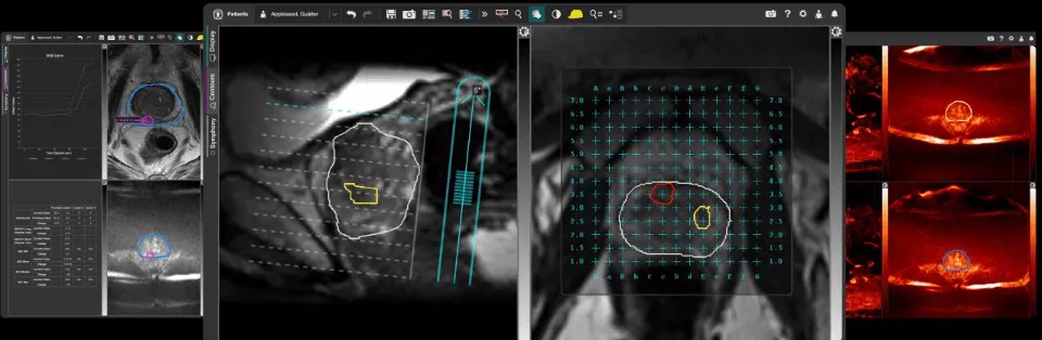 MRI fusion biopsy of the prostate