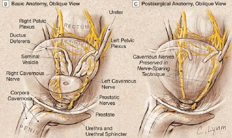 nerve sparing robotic prostatectomy showing preservation of neurovascular bundles