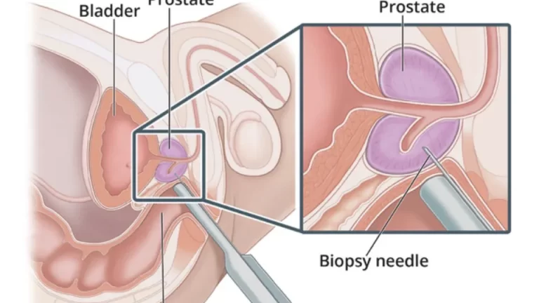 ultrasound guided TRUS prostate biopsy procedure