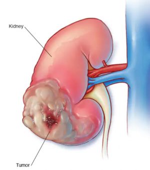 kidney cancer treatment in delhi
